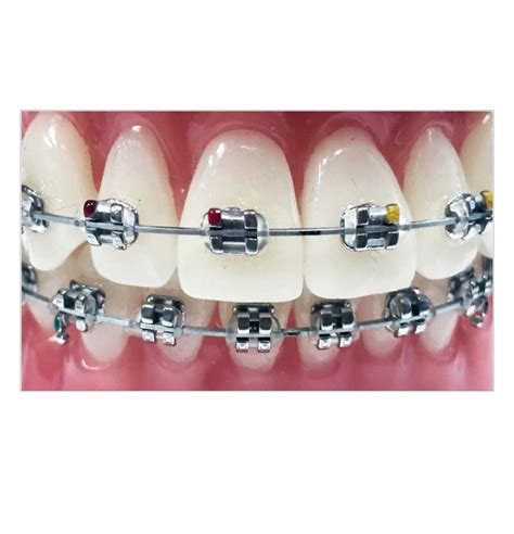 brackets mbt metalicos|brackets orthodontics.